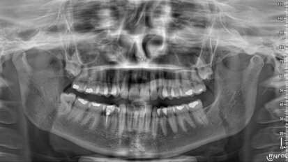 External cervical root resorption in anterior mandibular area: Diagnosis and treatment alternatives