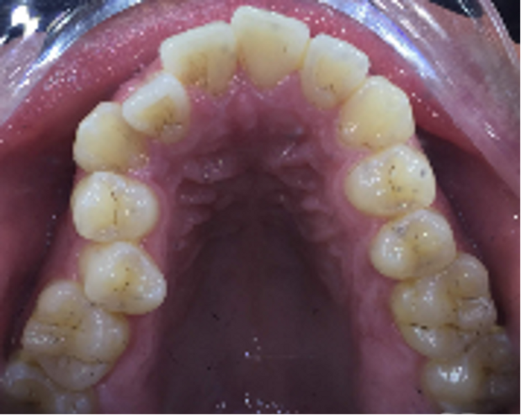 Fig. 27: Occlusal view of the maxillary arch.