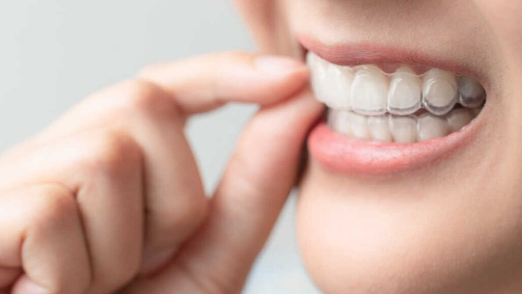 A prova di pandemia? Align Technology ha stabilito un nuovo record di vendita