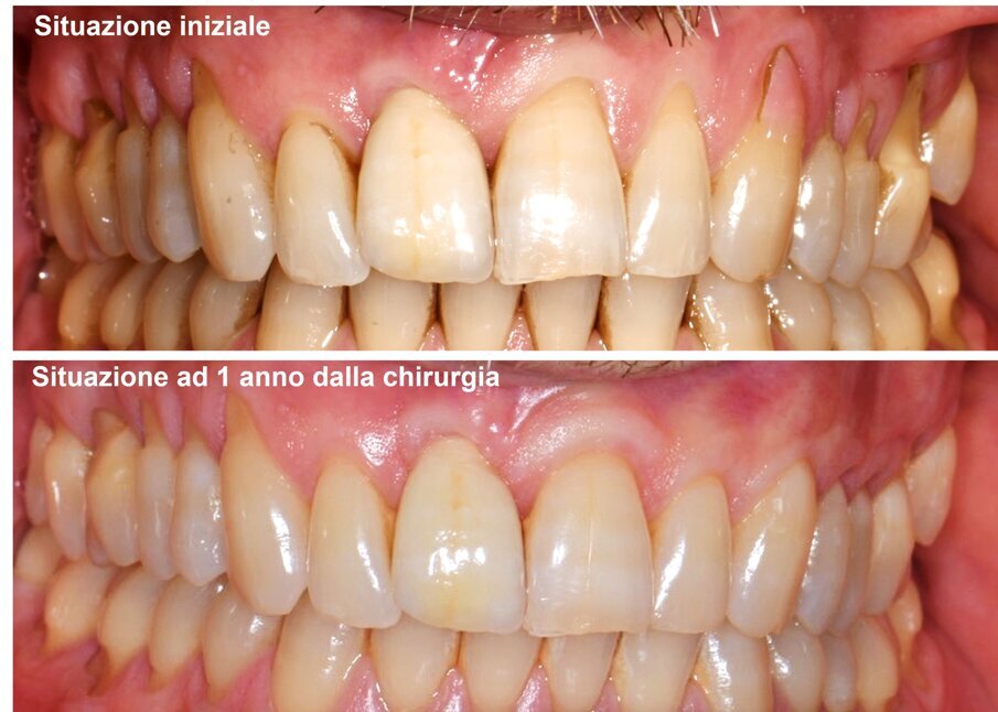 Figg. 10a, 10b - Confronto tra la situazione di recessione gengivale iniziale nel secondo quadrante e ad 1 anno di follow-up. Si noti l’ispessimento dei tessuti molli e l’ottima copertura radicolare raggiunta.