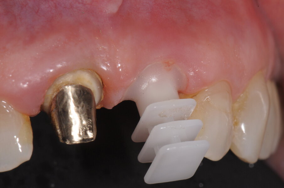 Fig. 11 - Alla presa di impronta analogica si provvede a inserire del composito flou nell’intercapedine tra il transfer e il tragitto transmucoso così da trasportare il volume condizionato dal provvisorio.