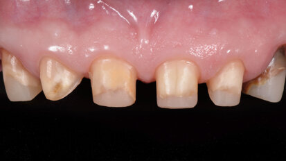 Erupción forzada en ortodoncia Erupción forzada en ortodoncia