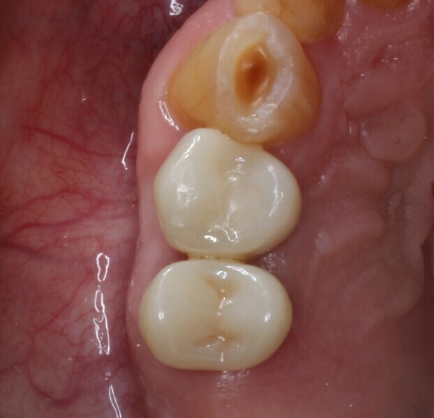 Fig. 23: Zirconia crowns in situ, occlusal aspect.
