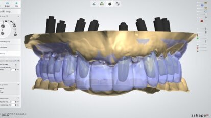 Kompleksowa terapia implantologiczna z zastosowaniem CBCT, technik augmentacyjnych i CAD/CAM