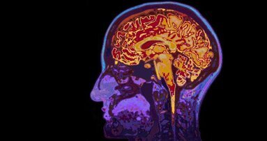 Pesquisadores encontram a relação entre bactérias orais, micro hemorragia cerebral e acidente vascular cerebral