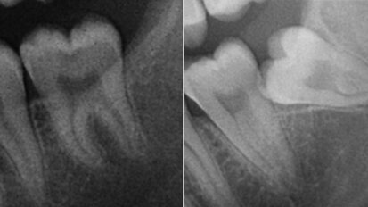 Importance of a preoperative radiographic scale for evaluating surgical difficulty of impacted mandibular third molar extraction
