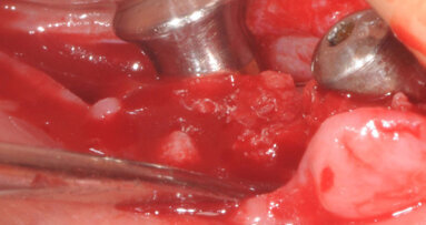 Restauro di un settore postero-inferiore atrofico con impianti extracorti da 4,5 mm di lunghezza