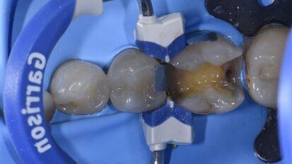 Controllo del contatto prossimale con sistema Garrison Composi-Tight 3D Fusion Sectional Matrix