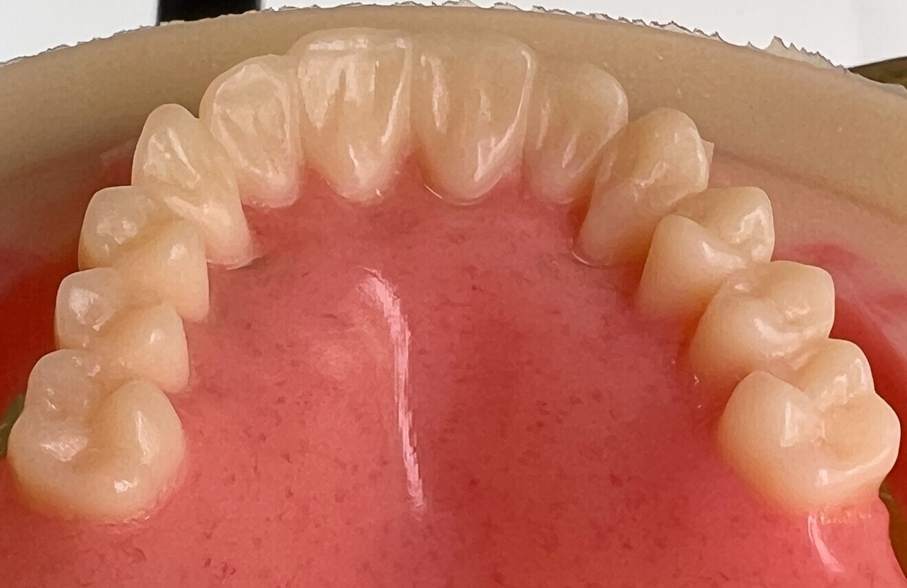 Fig. 10: Extremely high level of morphological and surface detail produced with the simultaneous monolithic milling of the pink aesthetics and the teeth.