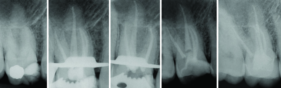 Fig. 8 - Terapia canalare 1.6 controllo a 17 anni.
