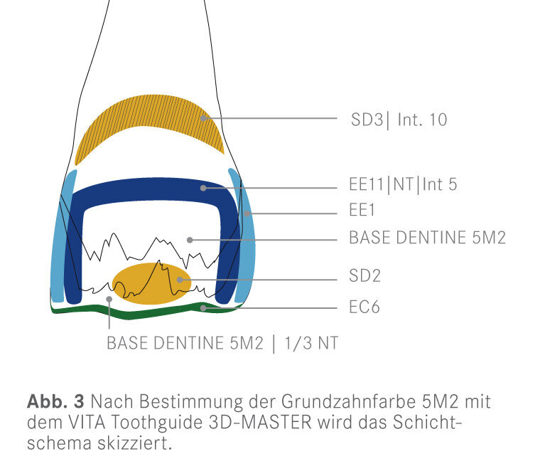 Fig. 3: After determining the basic tooth shade 5M2 with the VITA Toothguide 3D-MASTER, the layer scheme is sketched.