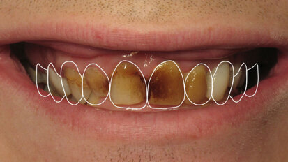 Figura 2. Simulación numérica de la sonrisa basada en la situación inicial Figura 2. Simulación numérica de la sonrisa basada en la situación inicial
