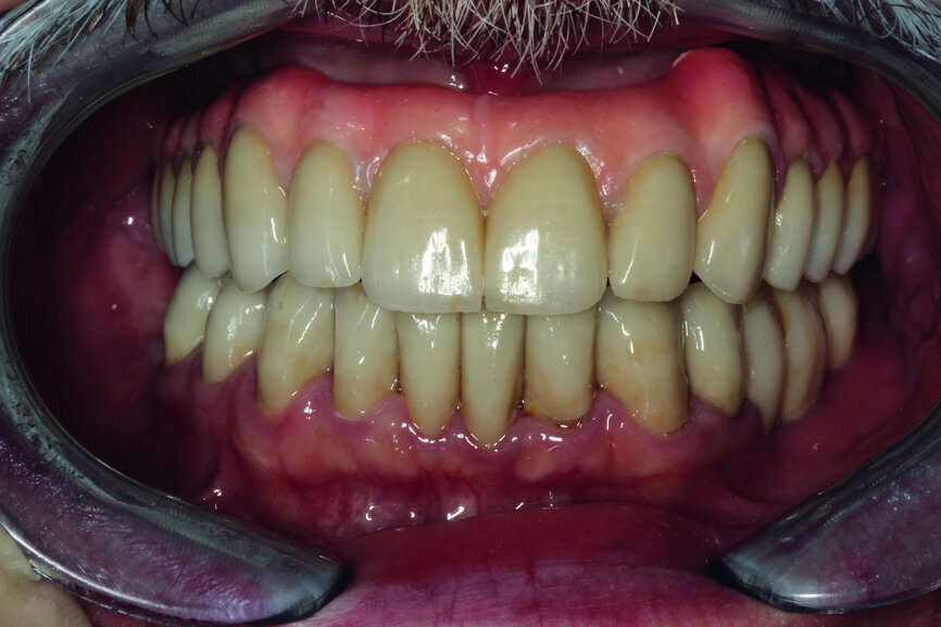 Fig. 27: Final prosthetic restoration in patients’ mouth.