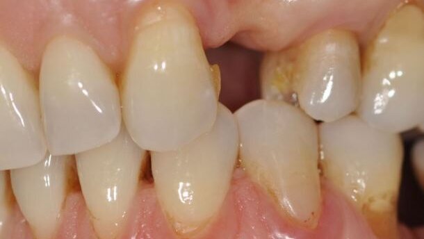 Pogrubienie dziąsła zrogowaciałego w odcinku estetycznym w leczeniu implantologicznym