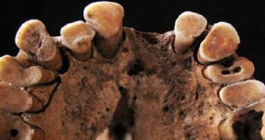 Ook jagers-verzamelaars hadden cariës