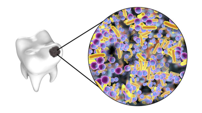 Researchers sequence rare bacterium that causes rampant dental caries