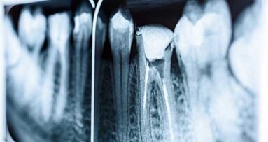 Пациент умира от анестезия след кореново лечение