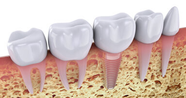 Zóny na CBCT čelisti