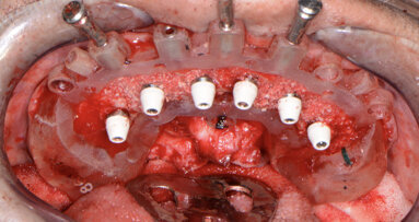 Predictable guided implant placement for full-mouth reconstruction