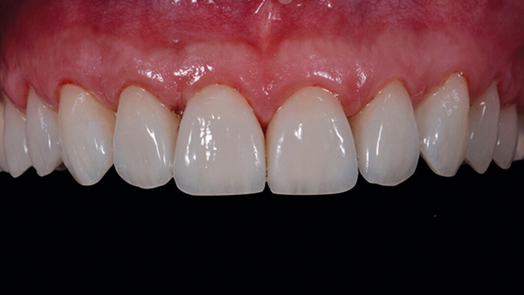 Fig. 16f. Resultado final inmediatamente después de retirar dique de goma.