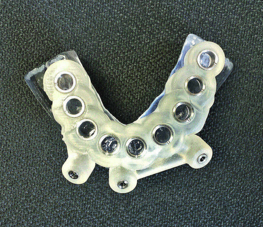 Fig 8 Guide chirurgical pour implants mandibulaires