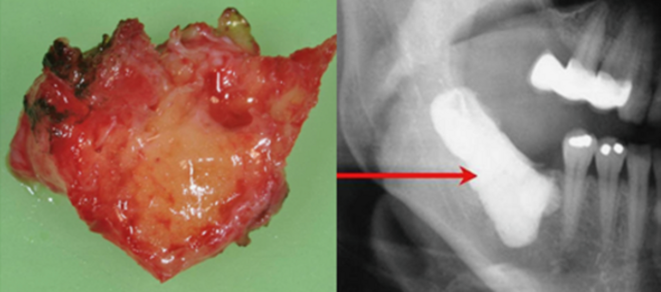 Fig. 7 : Échantillon de FDOJ collecté, et mise en évidence du volume cureté à la radiographie panoramique avec agent de contraste.
