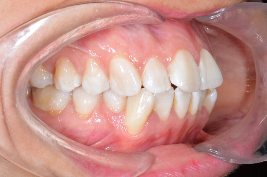 Fig. 2a: Initial intra-oral photograph.