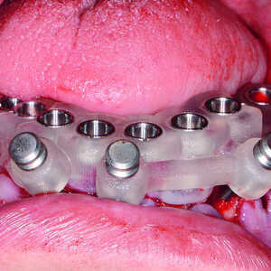 Fig-14-Guide-chirurgical-mandibulaire-stabilisé-300x300-