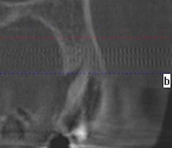 Fig. 1b - La sezione alla Cone beam.