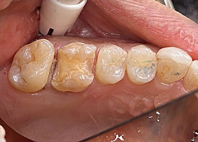 Fig. 6: After tooth preparation to remove the old composite restorations and caries.