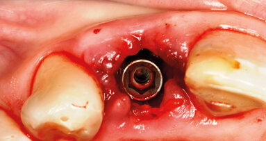 Impianto post-estrattivo in zona estetica. Le chiavi per un successo predicibile e stabile nel tempo