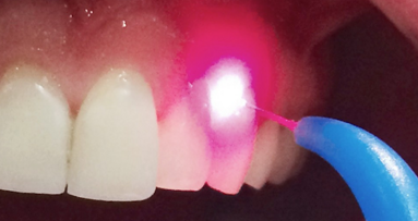 Curso Intensivo de Láser Aplicado a Odontología Moderna