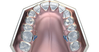 How to avoid extractions when treating malocclusions using MRC’s Bent Wire System (BWS) and Trainer System for arch development