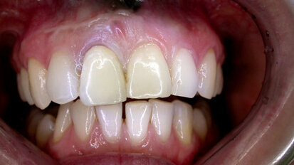 Der lange Weg zur Frontzahnästhetik