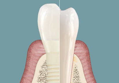 Patent Symbionic Teeth