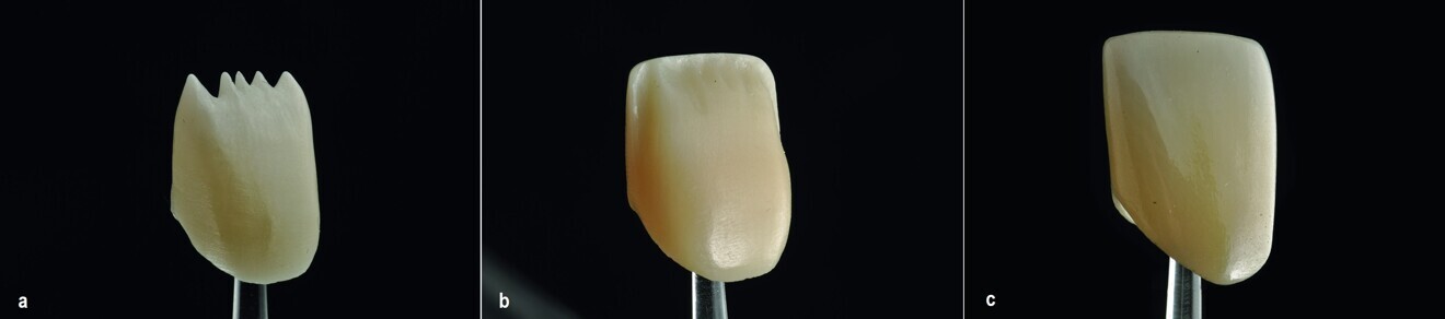 Unlimited design options: a crown with a full micro-cutback (a), a crown with a vestibular cutback (b) and a monolithic crown (c). (Images: Daniele Rondoni)