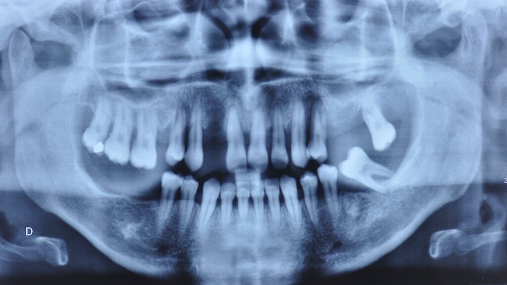 L’harmonisation du plan de traitement prothétique