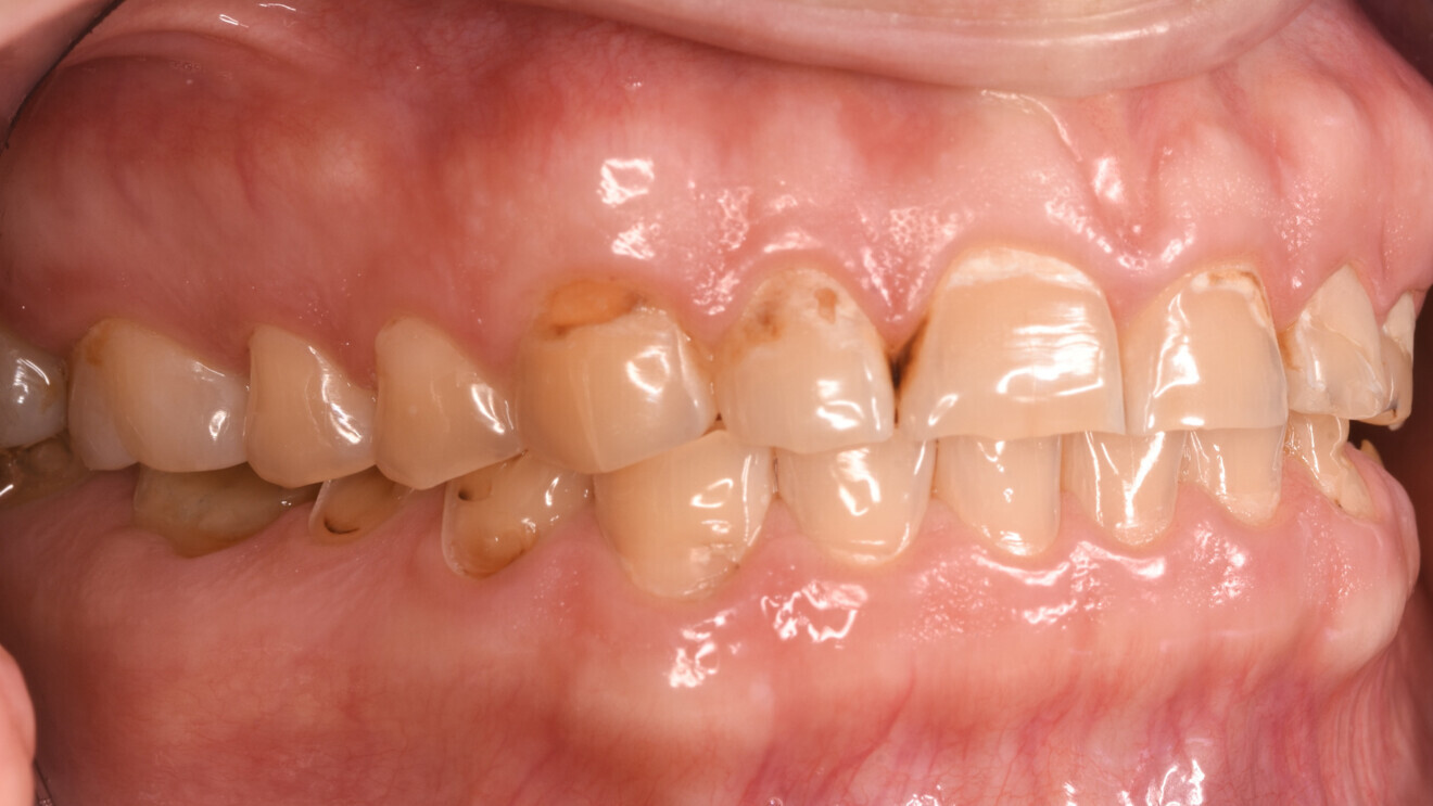 Fig. 1c: Initial situation. Right lateral view. 