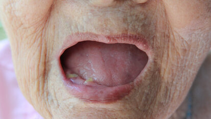 Study suggests causal link between tooth loss and heart disease Study suggests causal link between tooth loss and heart disease