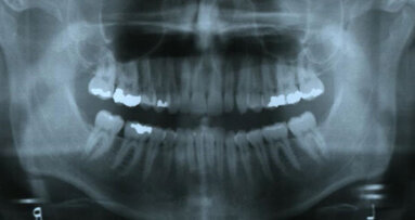 ClearCorrect treatment of crowding and constricted archforms