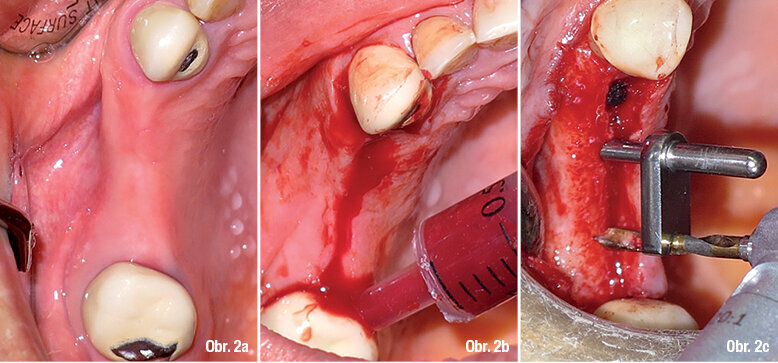 Popis chirurgické procedury  Obr. 2a: Klinický stav alveolárního hřebene, který ukazuje bezzubý úsek 14, 15 a 16 před započetím chirurgického zákroku  Obr. 2b: Krestální incize a sbírání krve pro pozdější použití pomocí sterilní kanyly  Obr. 2c: Preparace pilotem na straně implantace se současným prováděním ISL