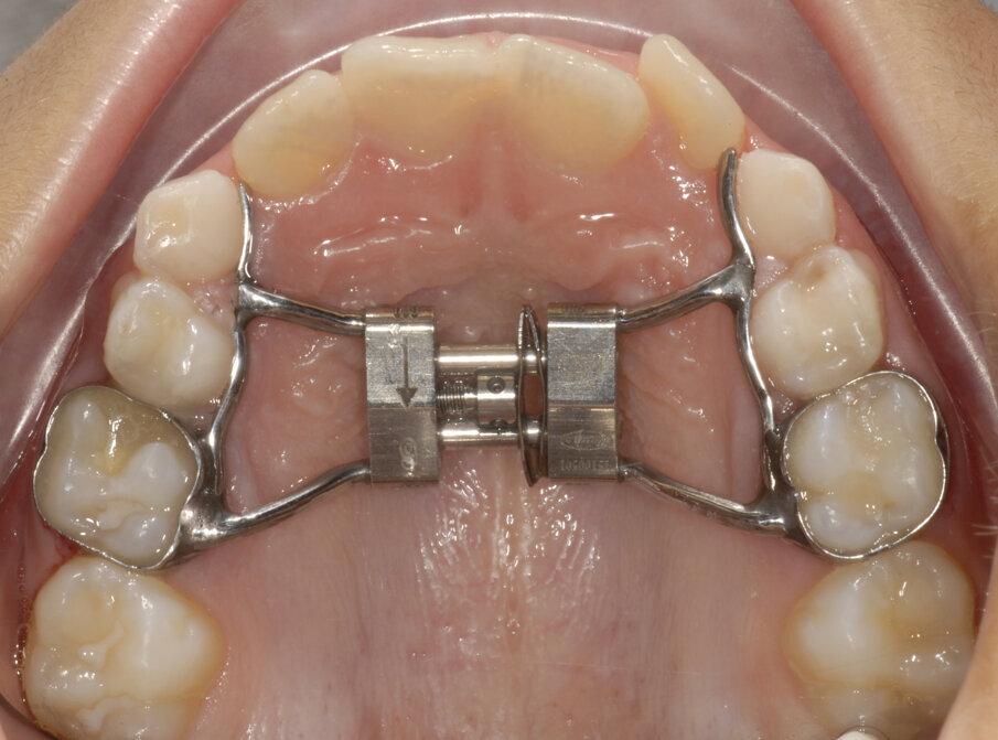 Fig. 15_Leaf expander al termine dell’espansione.