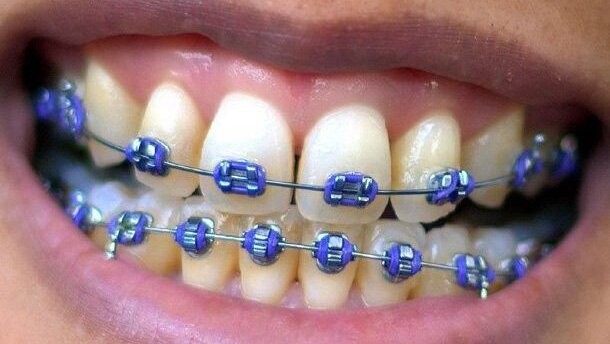 Aparat ortodontyczny – nie tylko dla dzieci i młodzieży