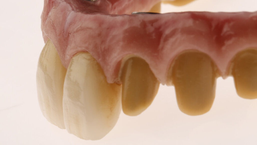 Full-arch rehabilitation with lithium disilicate secondary crowns luted on to the primary framework