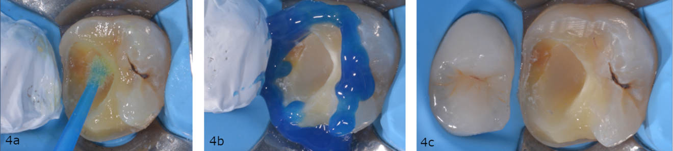 Figs. 4a–c : Préparation pour restaurations partielles collées postérieures.