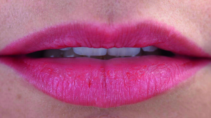 Fig. 17c: Lips at rest, exposure of the incisal edges.