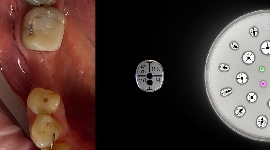 Fig. 8_Selezione di un profilo m1M VPI Cervico per la generazione di un moncone personalizzato.