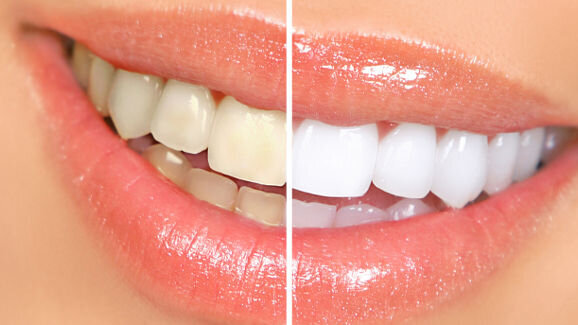 Zahnaufhellung – eine sichere Behandlung?