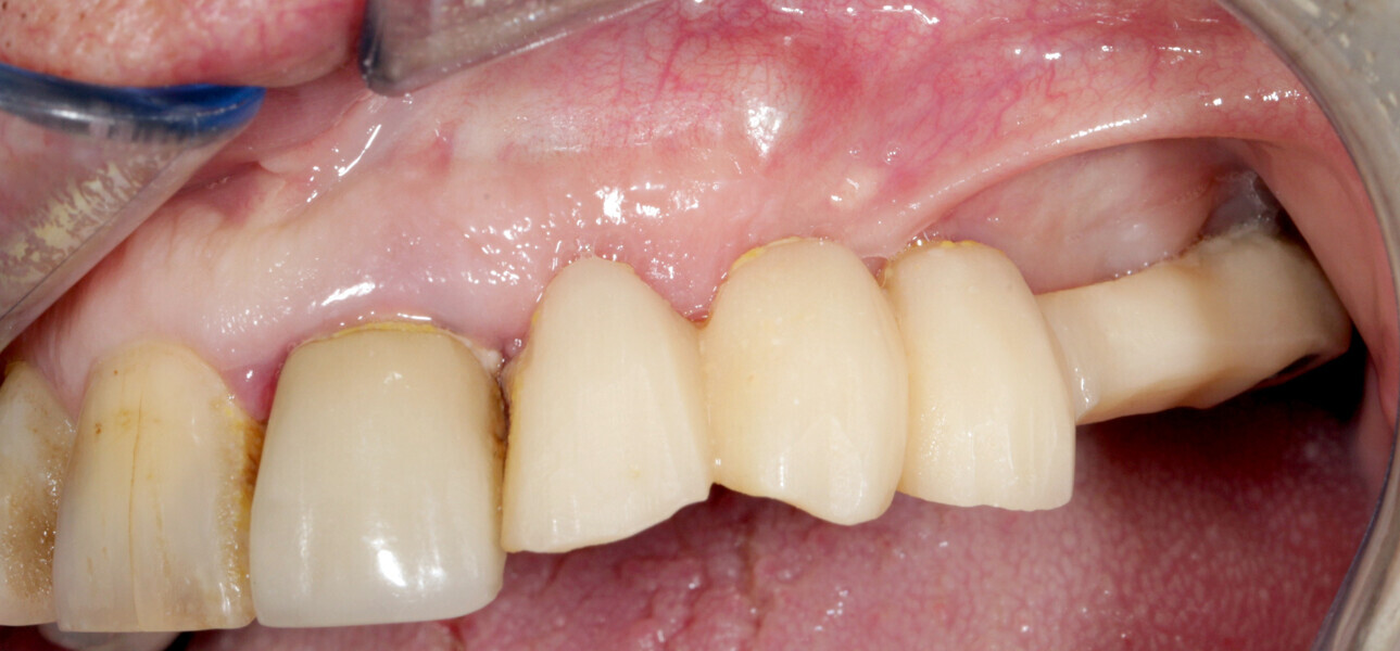 Fig.13: The osteosynthesis screws were not removed because they were not visible under the gingiva.