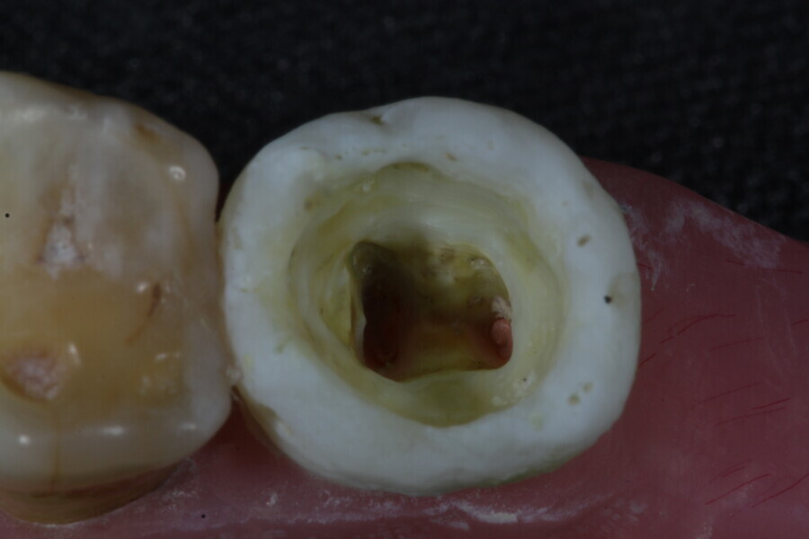Fig. 21: Endodontically treated third molar.